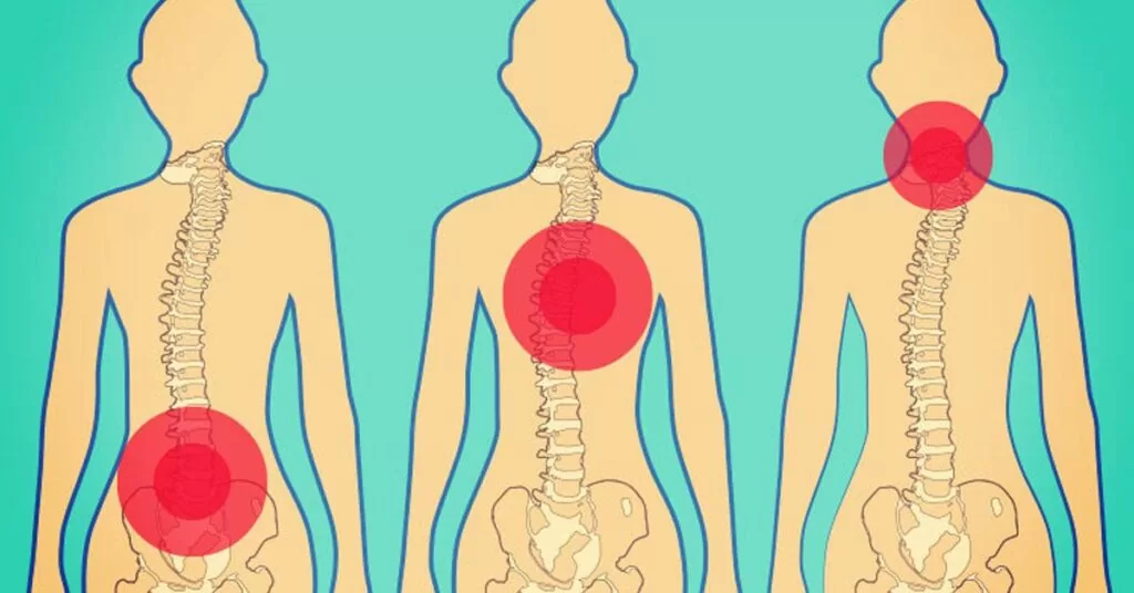 الانزلاق الغضروفي